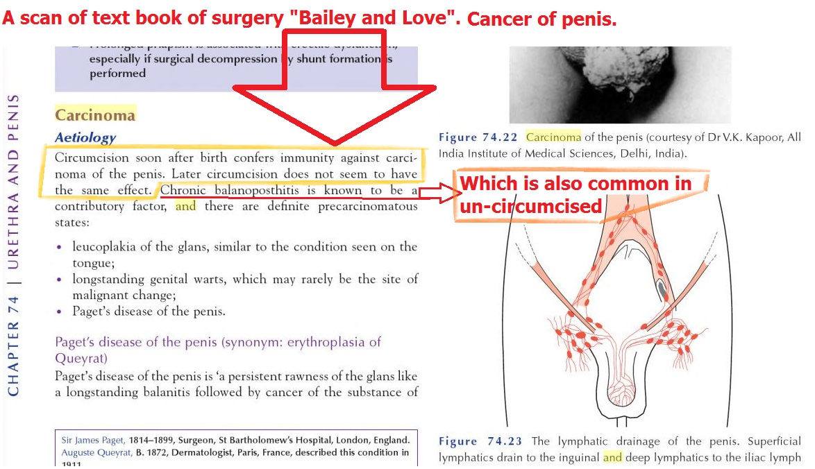 Circumcision - Bailey and Love.jpg