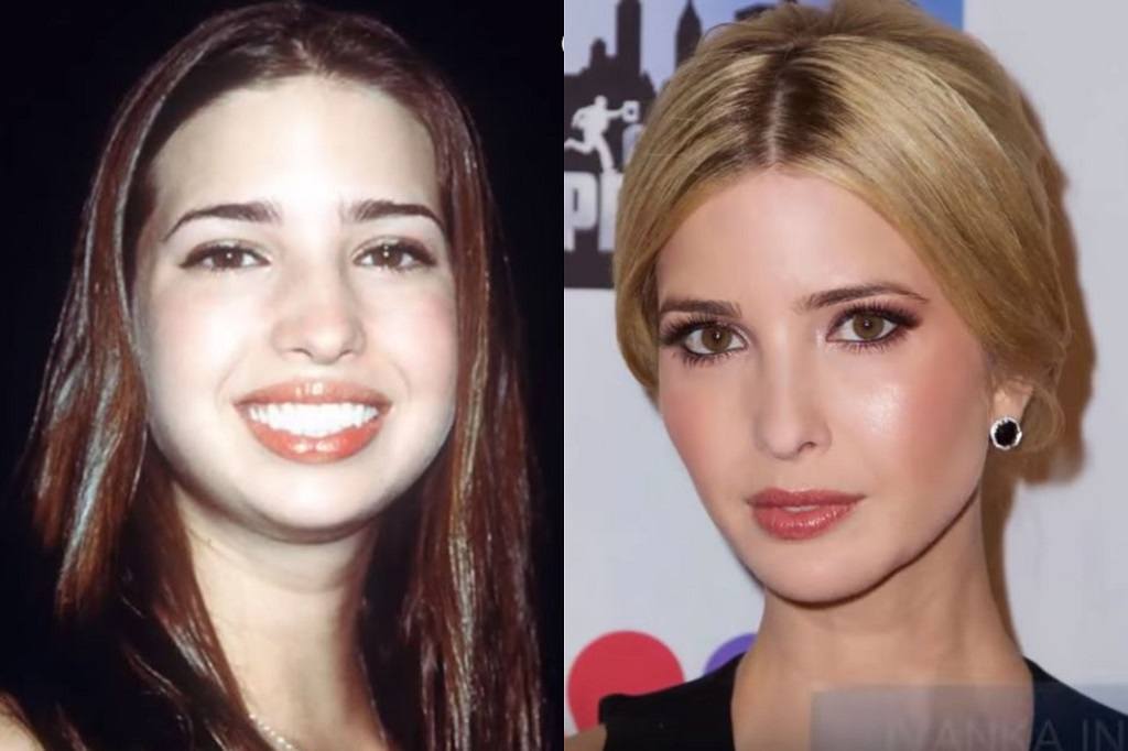 Ivanka-Plastic-Surgery.jpg