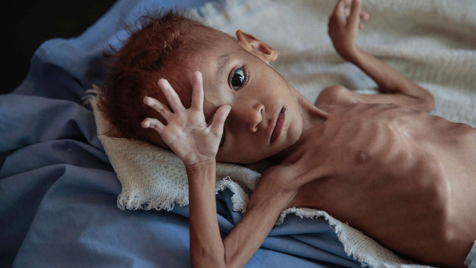 yemen-hunger-child-ap-ps-181121_hpMain_16x9_1600.jpg