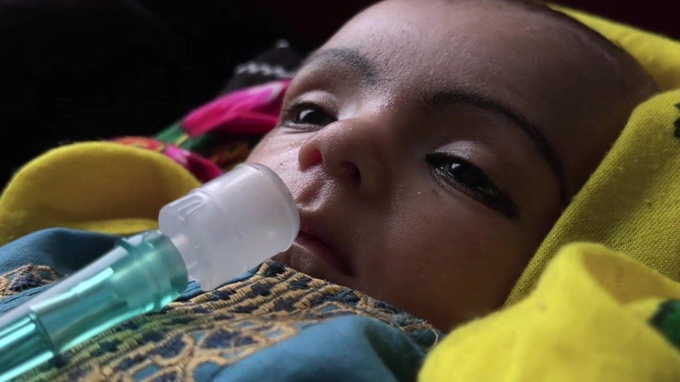 A child in the Ghol hospital with an unsecured oxygen tube lying on its chest