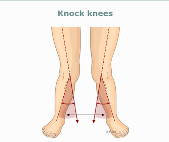 Knock-knees.jpg