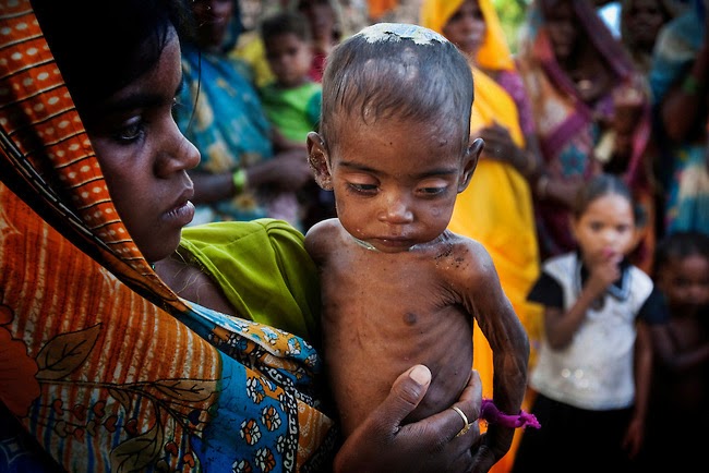 Malnutrition-India-003.jpg