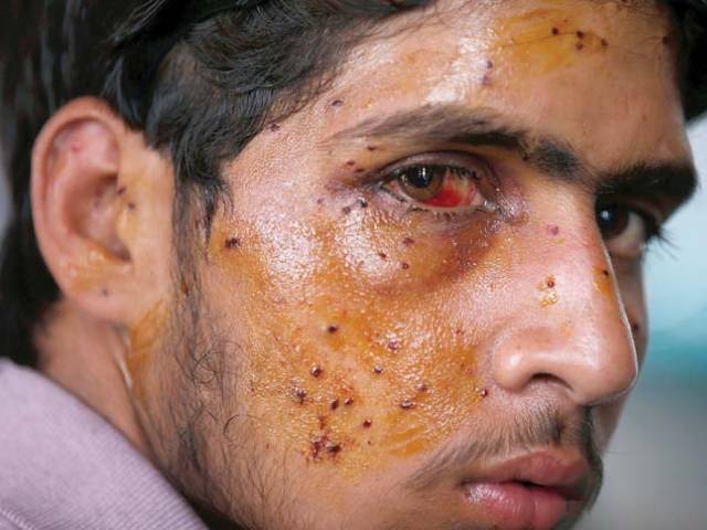 1153244-KashmirpelletinjuriesReuterscopy-1469997268-471-640x480.jpg