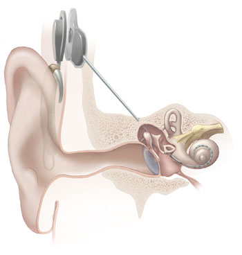 Cochlear_implant.jpg