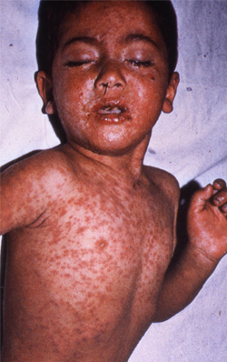 measles_3.jpg