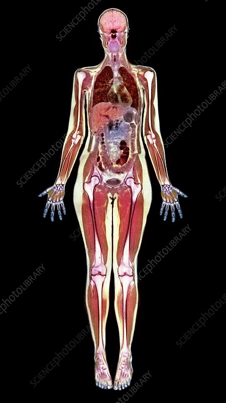 C0072250-Thin_woman%2C_MRI_scan-SPL.jpg