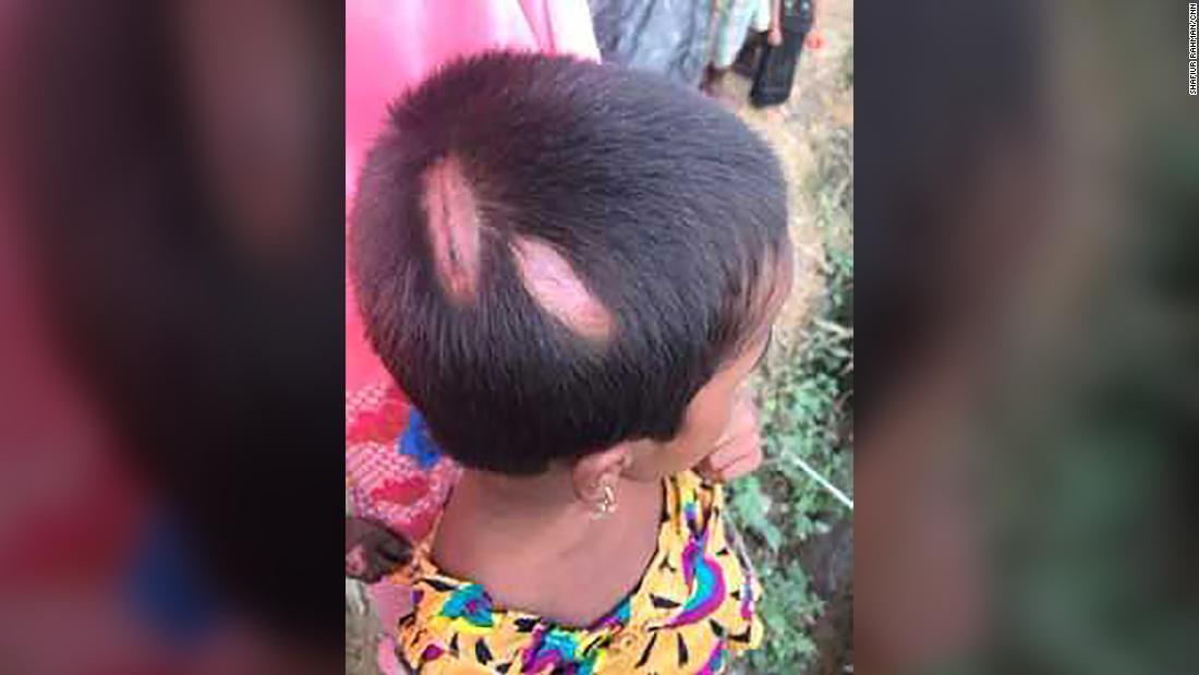 171110142239-rohingya-razia-head-injury-super-169.jpg