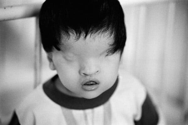 The dioxin in Agent Orange can affect the developing fetus. Minh Vin Gung has no trace of eyes.