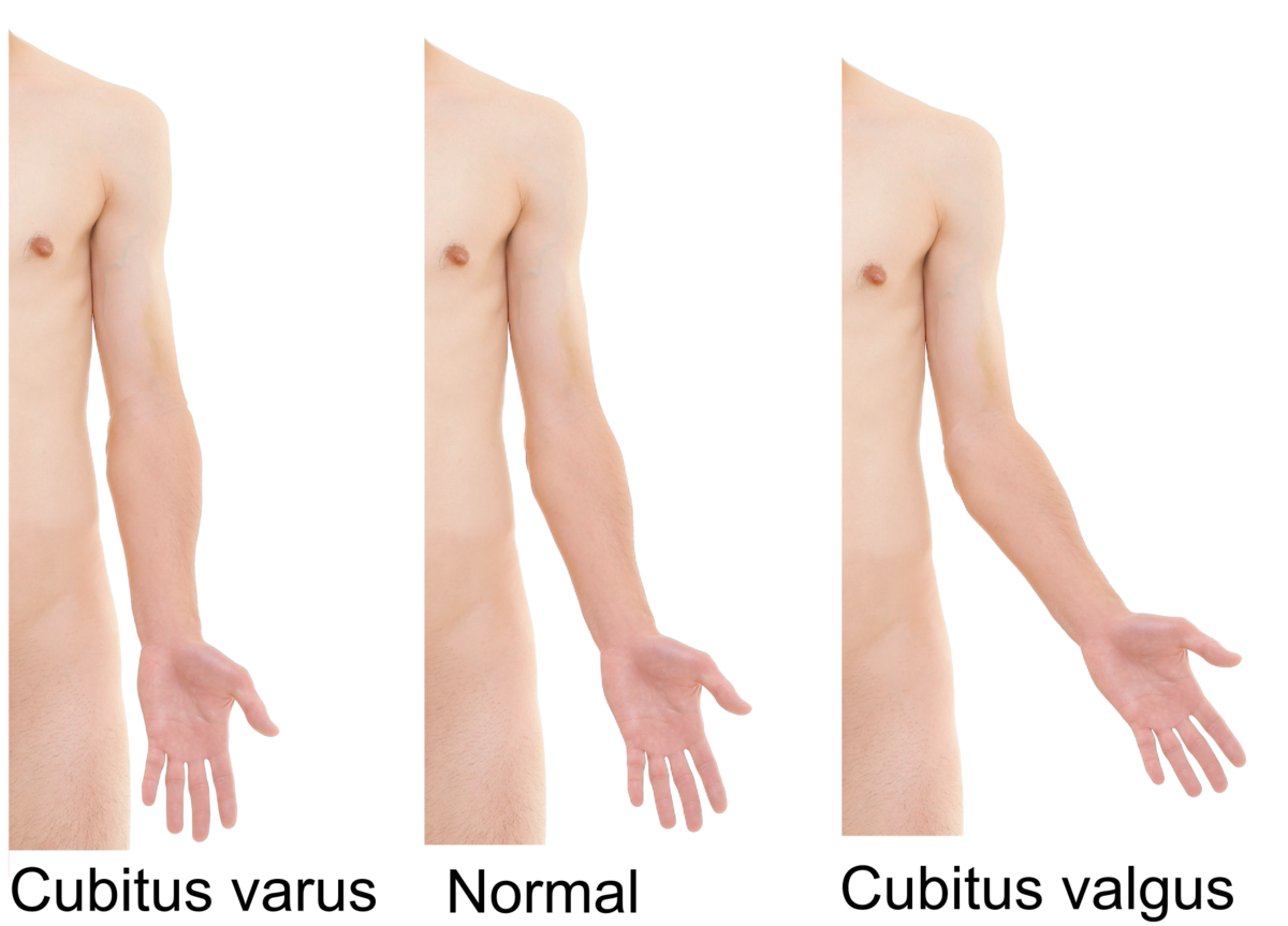 1200px-Cubitus_varus_and_cubitus_valgus.png