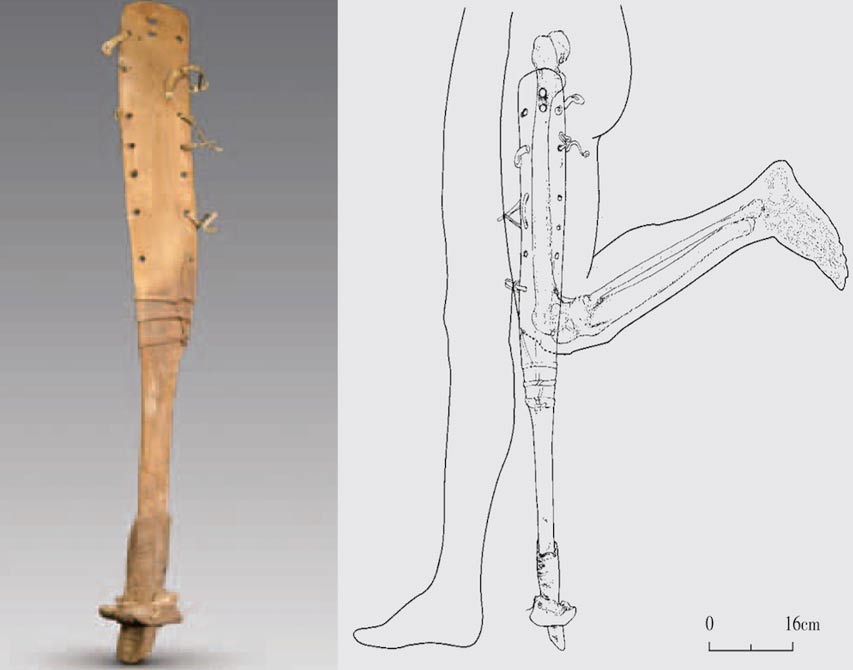 prosthesis-of-the-man.jpg